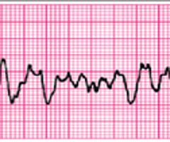 A 3 Year Old Unresponsive Apneic Child