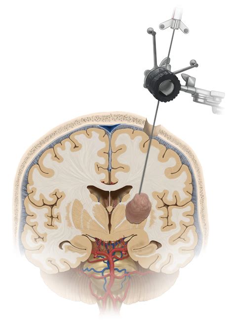 A 68 Year Old Female Undergoes Stereotactic Needle Biopsy