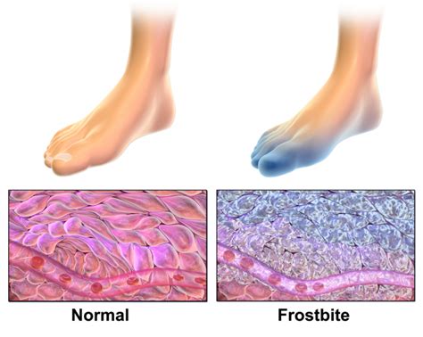 A Frostbitten Foot Can Be Identified By The Presence Of