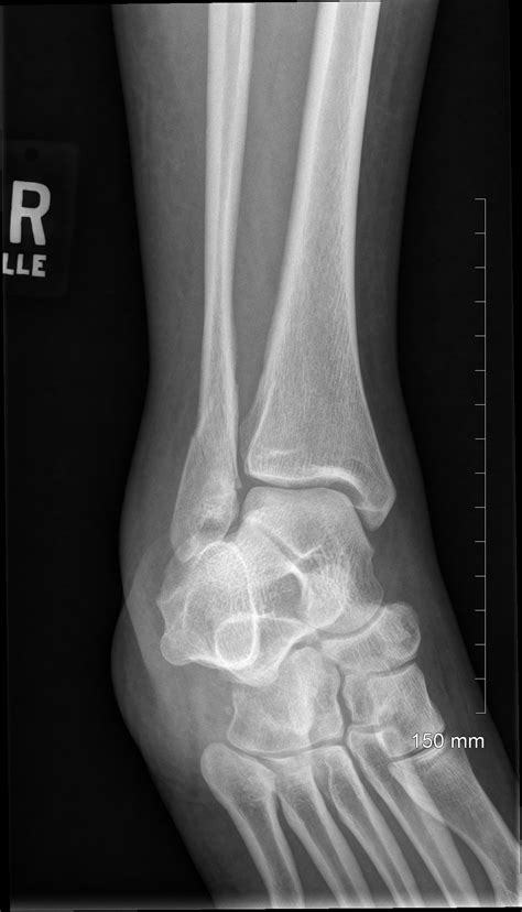 A Patient Presented With A Right Ankle Fracture