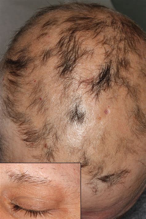 Acute Alopecia Eczema And Rapid Weight Loss