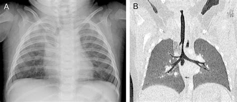 An Infant With A History Of Tracheal Stenosis Quizlet