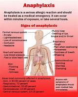 Anaphylaxis Is Most Accurately Defined As A N