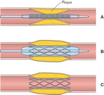 Coronary Artery Disease Hesi Case Study