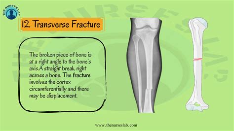 Orthopaedics In Action Fracture Repair Worksheet Answers