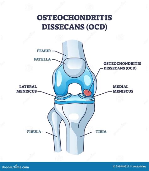 Osteochondritis Is An Example Of A