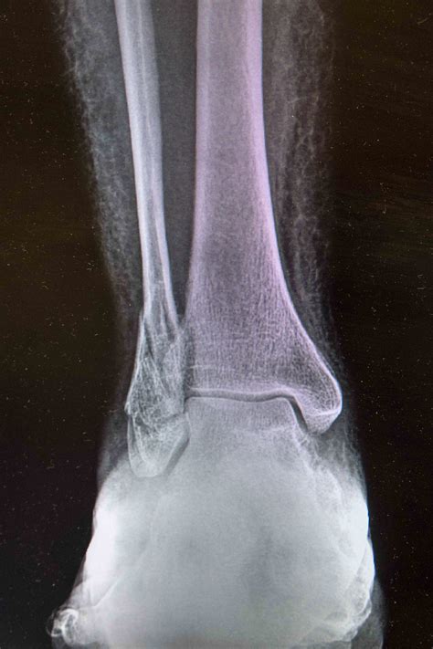 Pain In Fractured Ankle Integral Condition