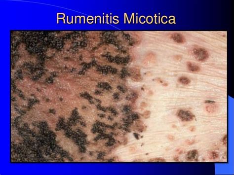 Select All The Proper Treatment Techniques For Rumenitis.