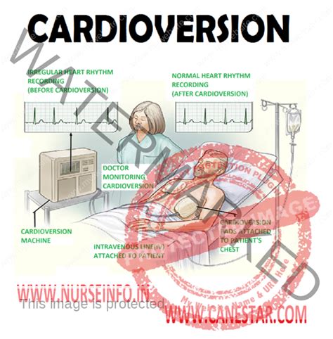 The Nurse Recognizes Which As Being True Of Cardioversion