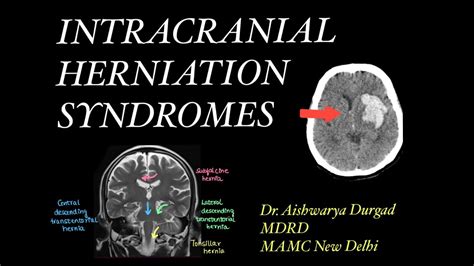 What Assessment Finding Is Consistent With Impending Herniation Syndrome