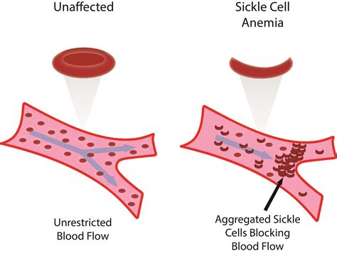 Which Statement By An Adolescent About Sickle Cell Anemia