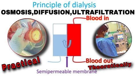 Which Three Statements About Dialysis Are True